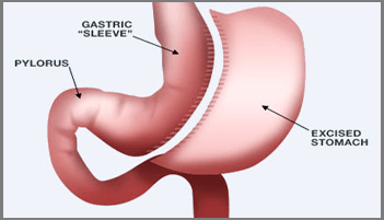 Gastric Surgery in Rajasthan, Gastric Surgery in Ahmedabad, Gastric Surgery in Gujarat, Gastric Surgery in Gandhinagar