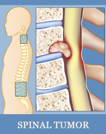 Spinal Tumor Treatment in Ahmedabad