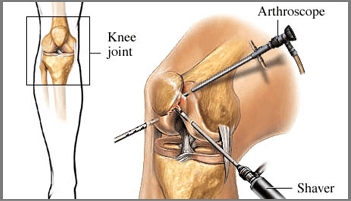 Arthroscopy Surgeon in Gandhinagar, Arthroscopy Surgeon in Gujarat, Arthroscopy Surgeon in Rajasthan, Arthroscopy Surgeon in Ahmedabad