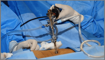 Endoscopic Spine Surgery Hospital In Ahmedabad, Endoscopic Spine Surgery in Ahmedabad, Endoscopic Spine Surgery in Gandhinagar, Endoscopic Spine Surgery in Gujarat, Endoscopic Spine Surgery in Rajasthan