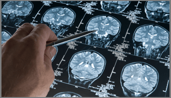 Neurologist Surgery in Ahmedabad