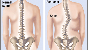 Scoliosis Surgery in Ahmedabad, Scoliosis Surgery in Rajasthan, Scoliosis Surgery in Gujarat, Scoliosis Surgery in Gandhinagar