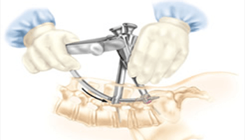 Microscopic spine surgery in Ahmedabad, Microscopic spine surgery in Rajasthan, Microscopic spine surgery in Gujarat, Microscopic spine surgery in Gandhinagar