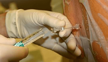Spinal Block Treatment in Ahmedabad