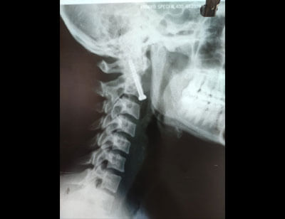 Spine Surgeon in Jodhpur